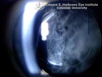 Vitreous Amyloidosis